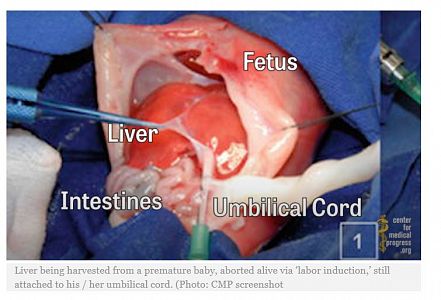 WATCH: University experiments on aborted baby parts, funding linked to Fauci