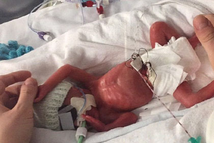 Twins who were born at the 24-week abortion limit defy the odds to become thriving toddlers