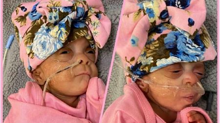 Mum shares amazing photos of premature twin girls who survived at 22 WEEKS