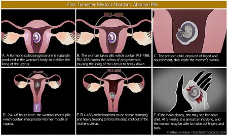 Court ruling sets precedent for use of unregulated abortion pills